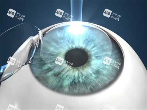 寧德華廈眼科正規(guī)嗎？做眼睛手術(shù)結(jié)果如何？患者真實經(jīng)歷告訴你答案！