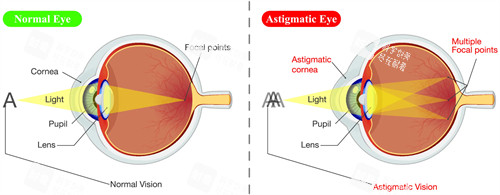 散光眼睛看不清楚東西的原理 散光眼睛看不清楚東西的原理