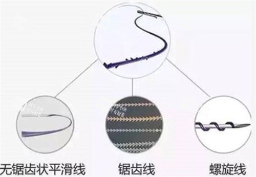 埋線提升不同類型的線 埋線提升不同類型的線