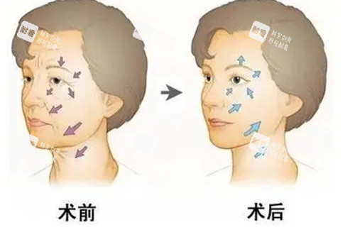 面部抗衰前后對(duì)比卡通示意圖 面部抗衰前后對(duì)比卡通示意圖