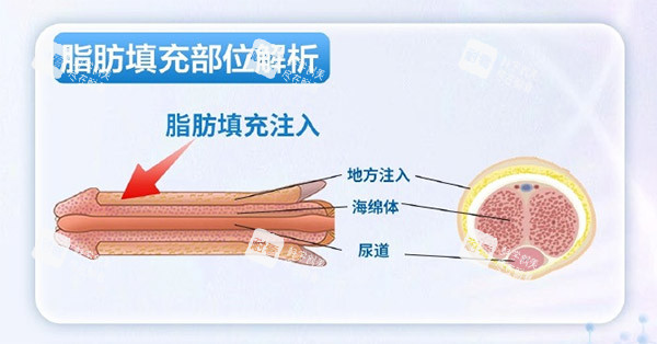 脂肪增大增粗照片 脂肪增大增粗照片