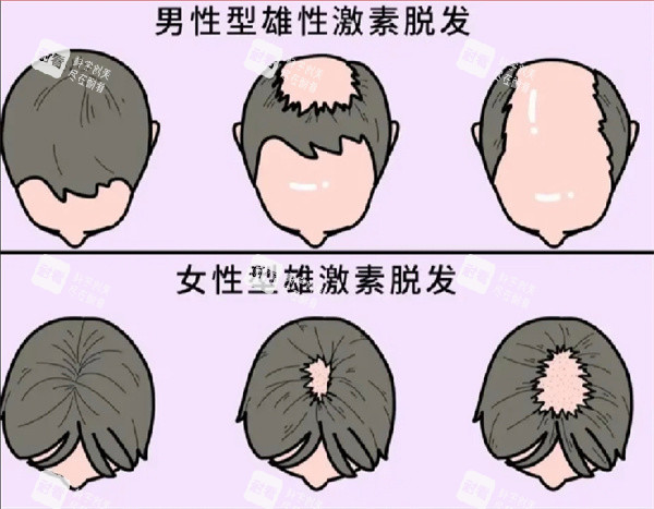 脫發(fā)圖片 脫發(fā)圖片