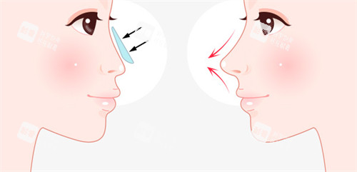 假體隆鼻前后對比 假體隆鼻前后對比