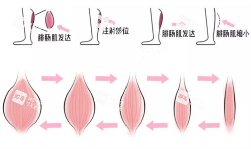 瘦腿注射前后對比 瘦腿注射前后對比