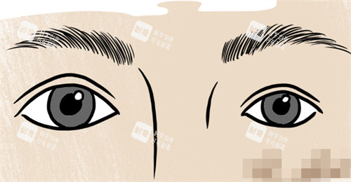 雙眼皮大小眼修復(fù) 雙眼皮大小眼修復(fù)