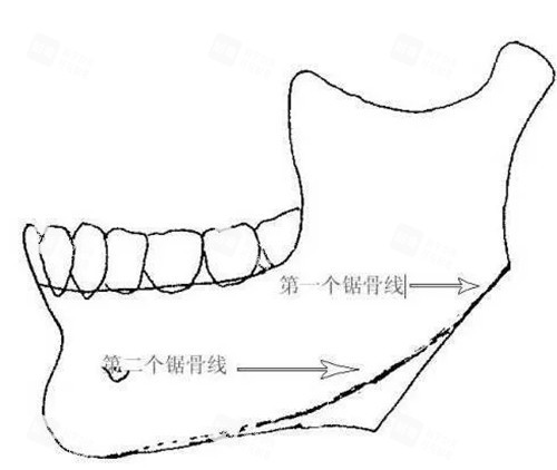 下頜骨截骨出現(xiàn)二次角示意圖 下頜骨截骨出現(xiàn)二次角示意圖
