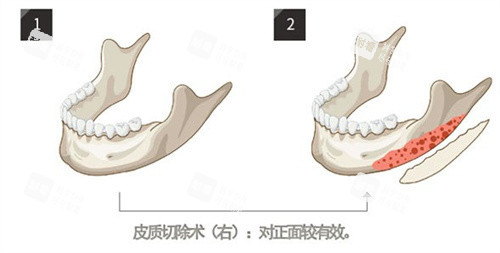 下頜角削骨 下頜角削骨