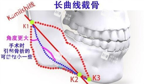 下頜角長曲線截骨的截骨位置 下頜角長曲線截骨的截骨位置