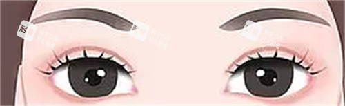 雙眼皮術(shù)后示意圖 雙眼皮術(shù)后示意圖