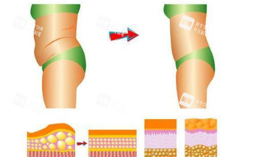 腰腹吸脂對比圖