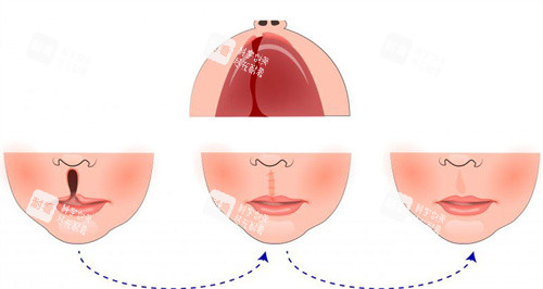 唇裂修復(fù)過程