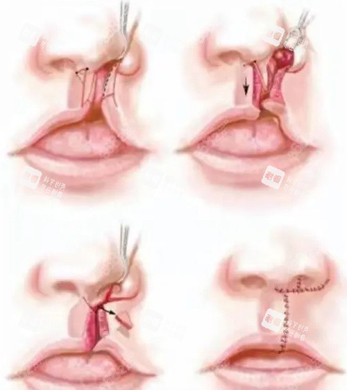 唇裂修復(fù)手術(shù)卡通圖