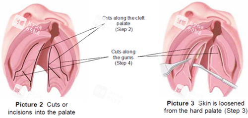 唇裂修復(fù)圖片一覽