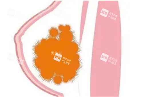 胸部奧美定 胸部奧美定