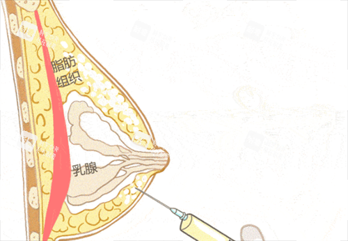 胸部奧美定注射物取出 胸部奧美定注射物取出