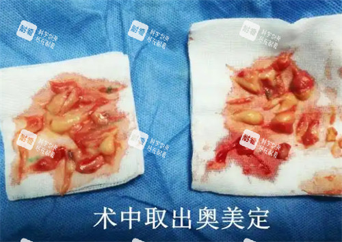 術中取出的奧美定 術中取出的奧美定