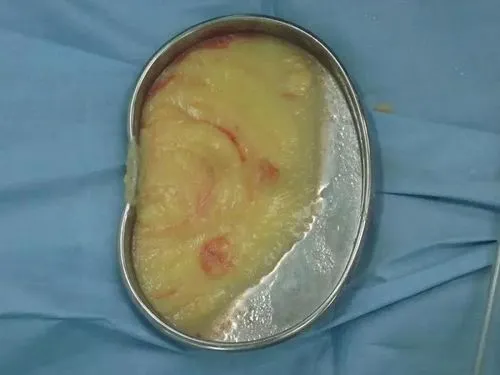 取出的奧美定實拍示意圖 取出的奧美定實拍示意圖