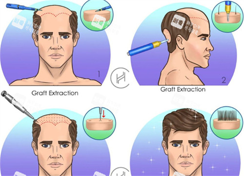 廣州植發(fā)哪家好？預(yù)算8K，對比荔灣尚俊11元起/高尚，背景vs定制化技術(shù)各有亮點！