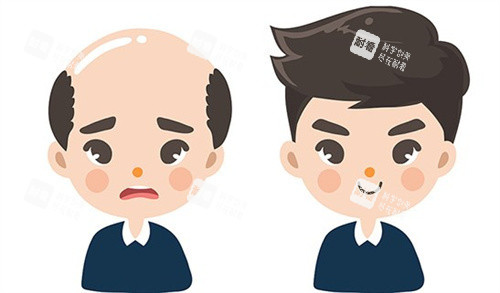 植發(fā)前后 植發(fā)前后