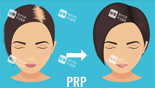 發(fā)縫加密植發(fā)前后對(duì)比圖 發(fā)縫加密植發(fā)前后對(duì)比圖