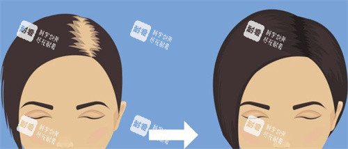 植發(fā)前后對(duì)比示圖 植發(fā)前后對(duì)比示圖