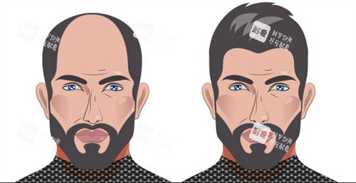 植發(fā)前后對(duì)比圖一覽 植發(fā)前后對(duì)比圖一覽