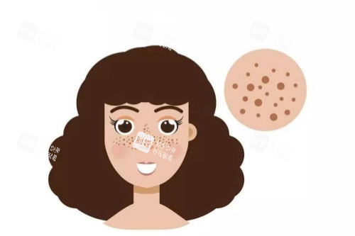 痘印卡通圖 痘印卡通圖