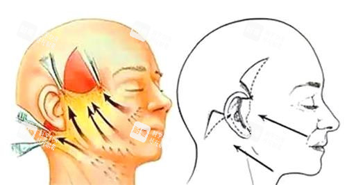 拉皮手術(shù)圖