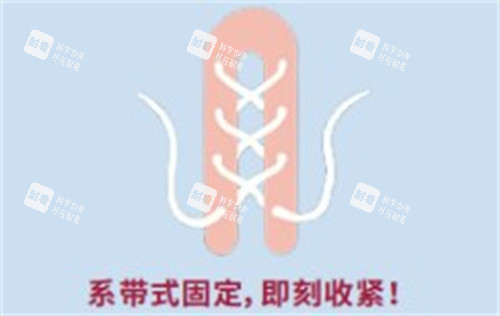 再生陰道緊縮術(shù) 再生陰道緊縮術(shù)