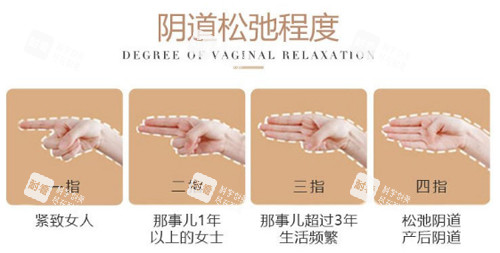 陰道松弛程度圖示 陰道松弛程度圖示