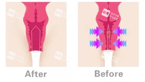 陰道緊縮對(duì)比圖 陰道緊縮對(duì)比圖