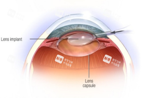 白內(nèi)障晶體放入示意圖