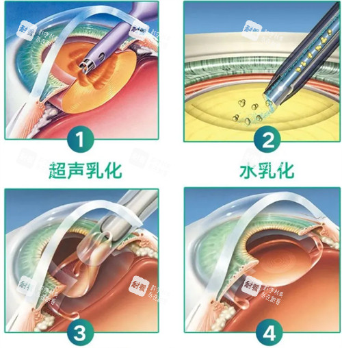 超聲乳化白內(nèi)障手術過程