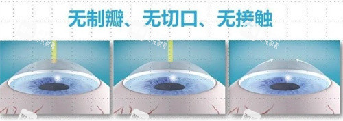 飛秒近視手術(shù)