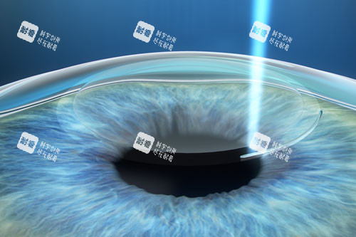 近視手術(shù)示意圖