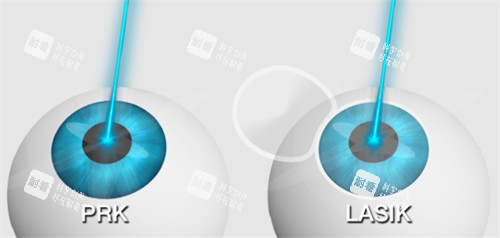 不同的近視手術(shù)
