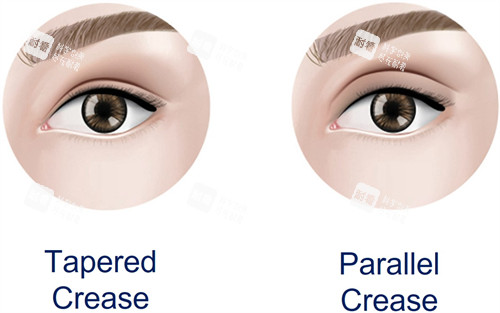 雙眼皮加寬手術(shù)前后對比圖