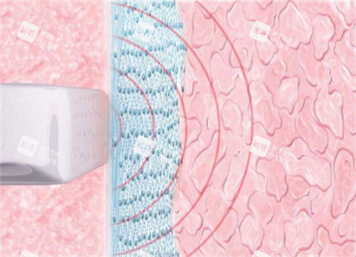 viveve薇蜜私密緊致儀器施術(shù)過(guò)程圖解