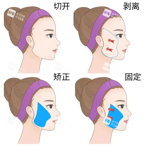 面部拉皮整形手術(shù)