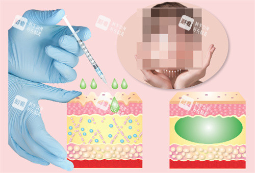 面部注射干細胞 面部注射干細胞