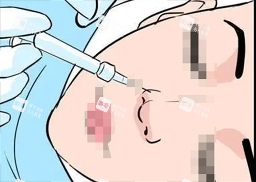 玻尿酸注射鼻子動(dòng)畫(huà)展示 玻尿酸注射鼻子動(dòng)畫(huà)展示