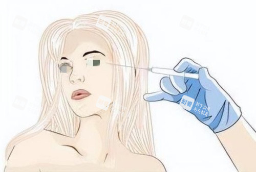 注射膠原蛋白去淚溝示意圖 注射膠原蛋白去淚溝示意圖