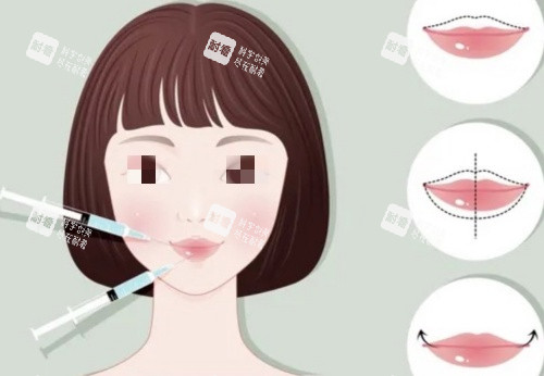 豐唇注射前后示意圖 豐唇注射前后示意圖