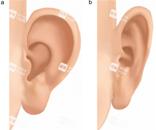 劉嘉鋒做耳朵舒展結(jié)果自然嗎？軟耳形態(tài)+健側(cè)對稱，社交距離無差異