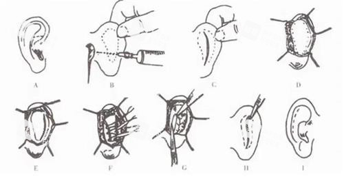 耳朵矯正手術(shù) 耳朵矯正手術(shù)