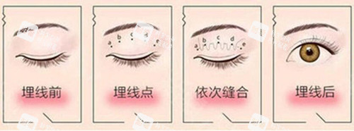 埋線雙眼皮過程示意圖片
