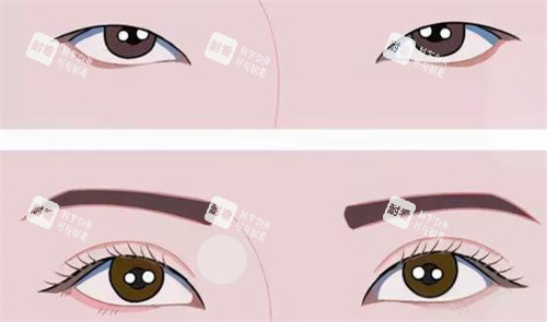 雙眼皮前后對比