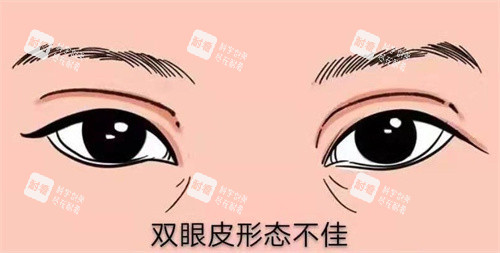 修復(fù)雙眼皮