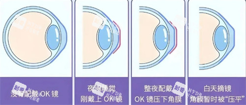 角膜塑形鏡佩戴前后對(duì)比圖