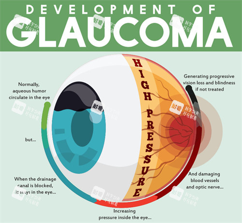 青光眼的眼睛結(jié)構(gòu)圖